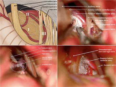 Long-Term Retrospective Analysis of Re-do Microvascular Decompression in Patients With Hemifacial Spasm